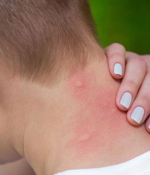 exemple allergie piqure moustique